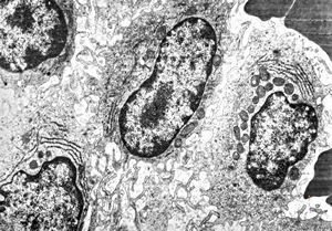 M,38y. | spleen - hairy cell leukemia M,38y. | spleen - hairy cell leukemia